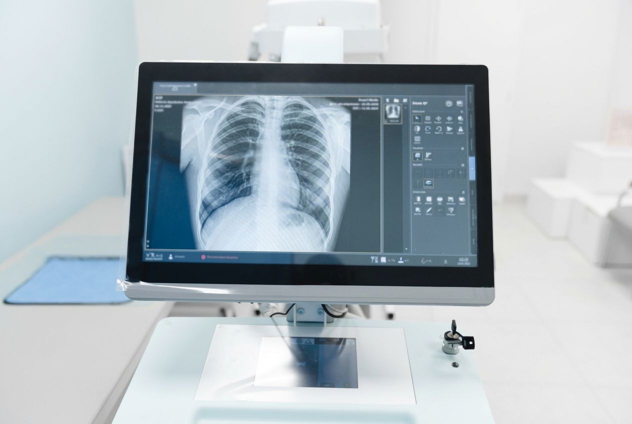 AI-based Tuberculosis Detection Using Chest X-ray